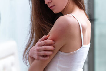 Eczema Relief Eczema Relief