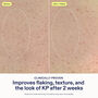 Skinfix KP PsO Smoothing Body Treatment, 5.07 fl. oz., , large image number 3