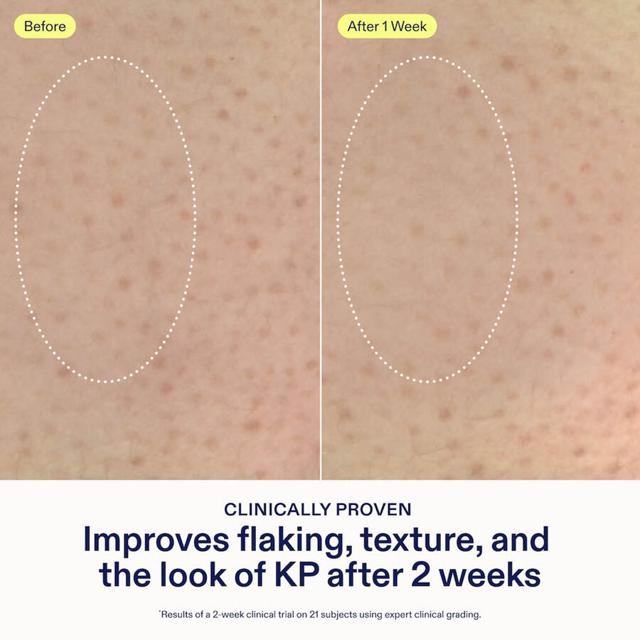 Skinfix KP PsO Smoothing Body Treatment, 5.07 fl. oz., , large image number 3